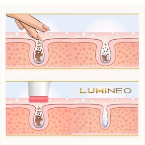 ЧЕТКА ЗА ЛИЦЕ 4 В 1 - LUMINEO PRO HOME SPA + ГЕЛ ЗА АКНЕИЧНА КОЖА 100 мл - РОЗОВА